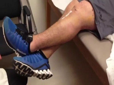 Best Knee joint Replacement Surgeon In Pcmc