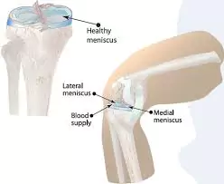 Meniscus Tear Treatment