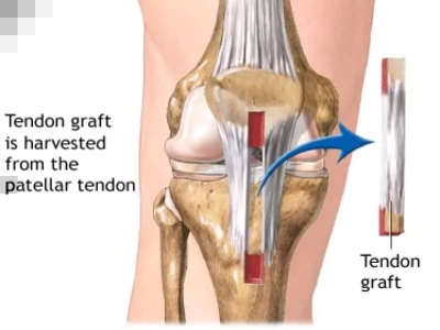 ACL surgery in pune pcmc
