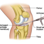 arthroscopic-meniscus-repair-surgery