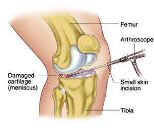 arthroscopic-meniscus-repair-surgery