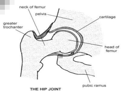 Hip replacement