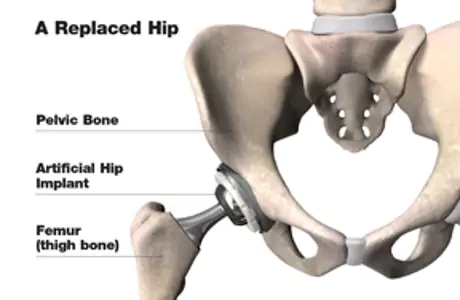 Hip replacement