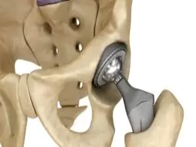 DAA - MIS Technique for Total Hip Replacement in Pune