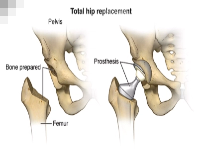 Hip replacement